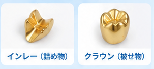 金歯の買取価格ガイド2-1